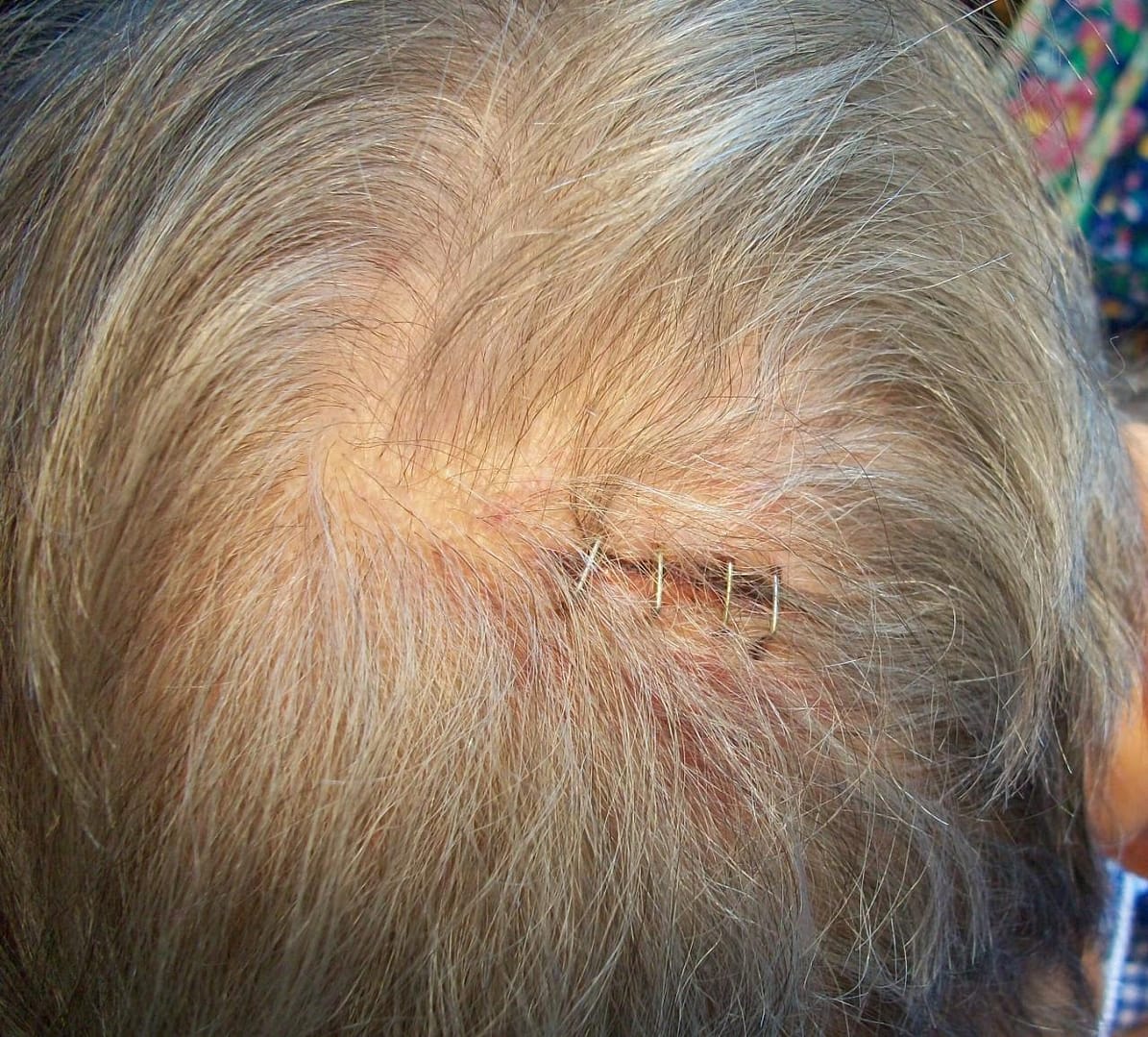 Understanding Why Staples Instead of Stitches on Head